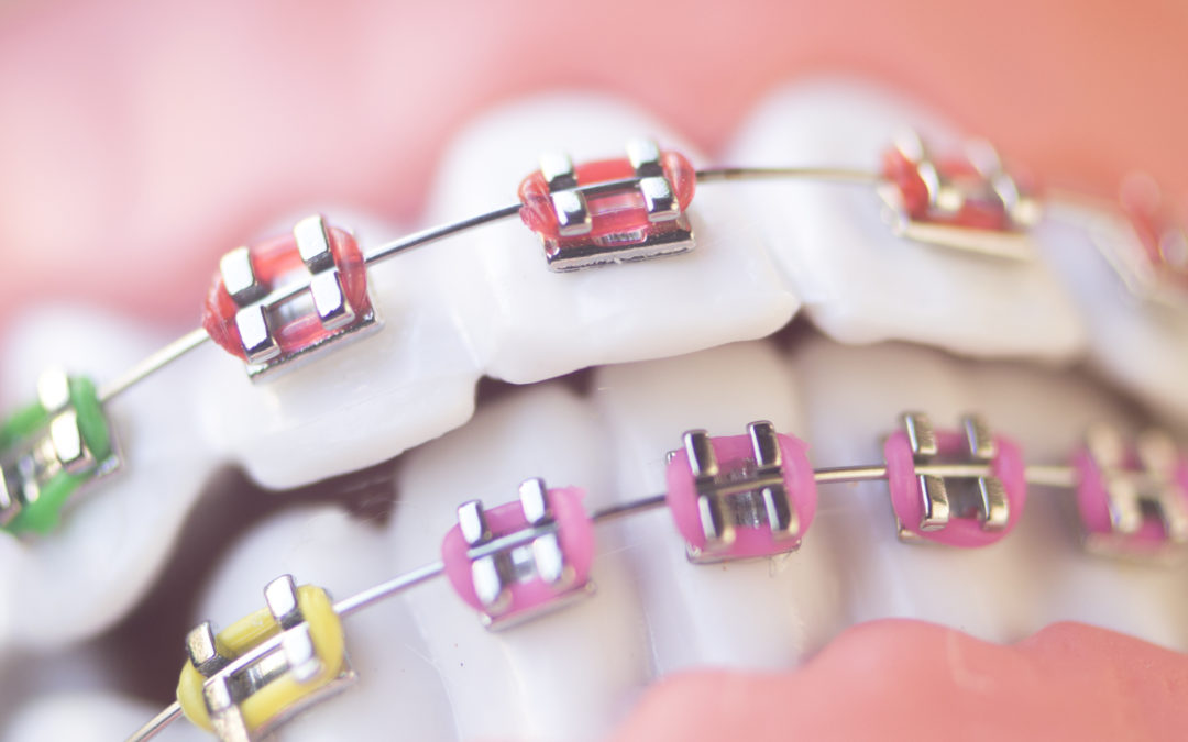 What Are “Two-Phases” of Orthodontic Treatment?