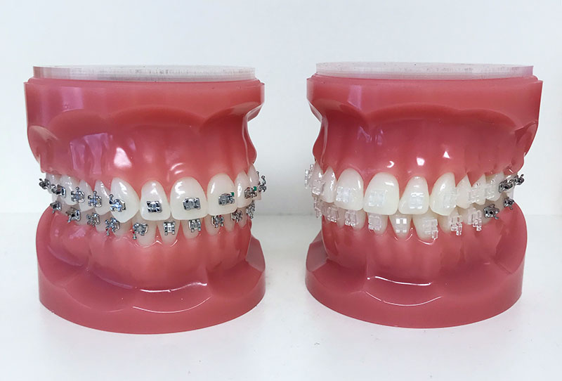 Steel and invisalign braces on the display