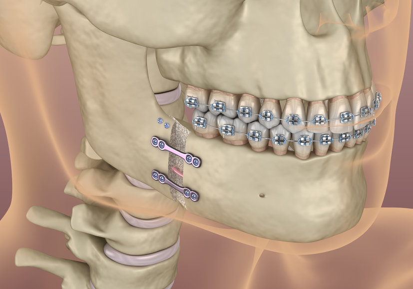 Mandibular Advancement surgery