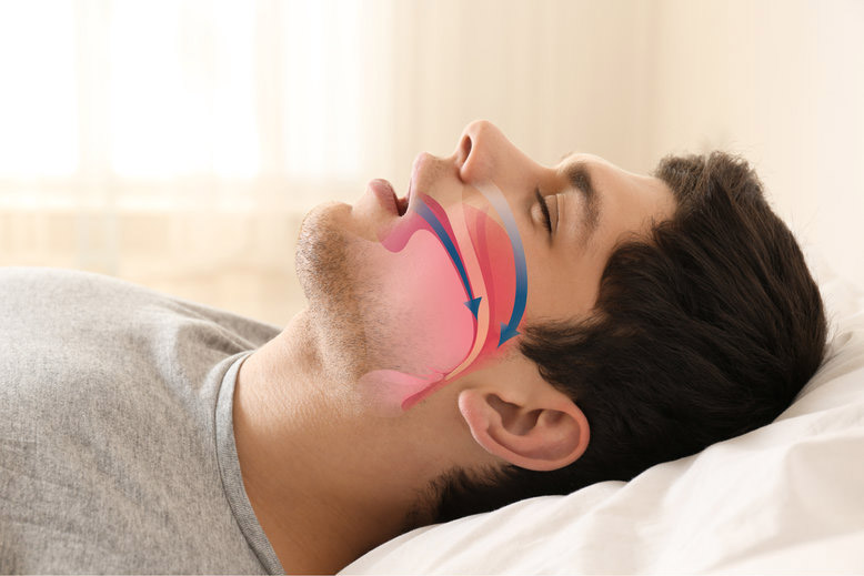 Illustration of obstructive sleep apnea