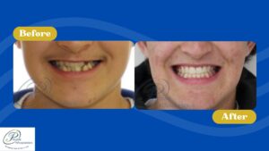Before and After photo showing smile changes.