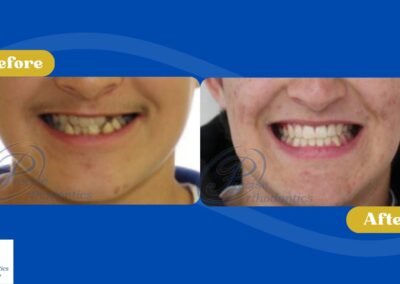 Before and After photo showing smile changes.