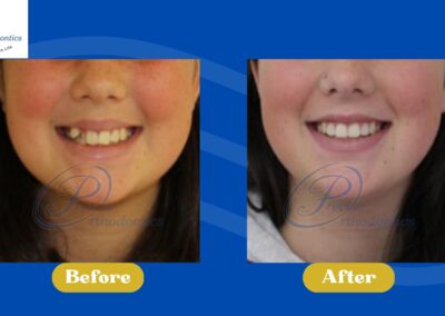 A patient's before and after smiling photos showing only mouth and nose.