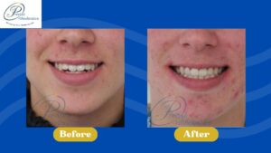 A patient's before and after smiling photos showing only mouth and nose.