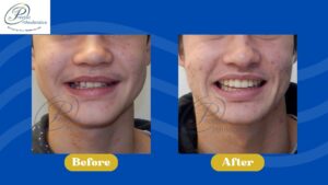 Before and After smiling photos, showing smile changes.