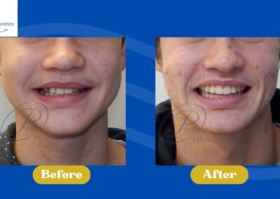 Before and After smiling photos, showing smile changes.