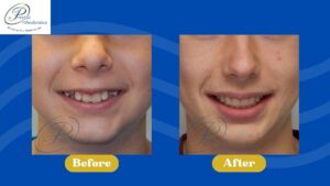 Before and after smiling photos, showing change after orthodontic treatment.