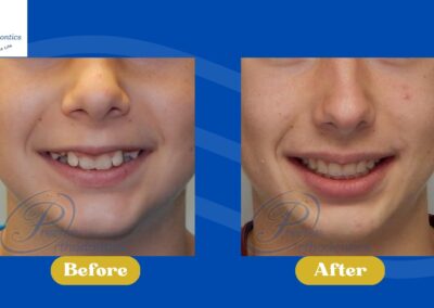 Before and after smiling photos, showing change after orthodontic treatment.