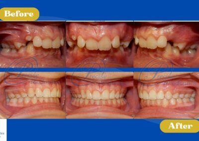 A patient's before and after orthodontic treatment, intraoral photos.