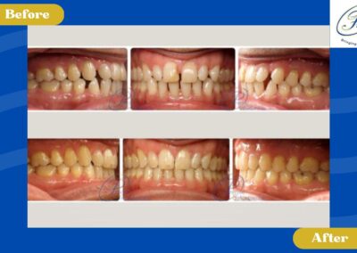 A patient's before and after orthodontic treatment, intraoral photos.