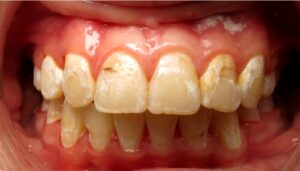 Tooth Decay Caused by Soda while in braces