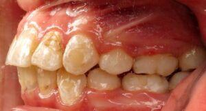 Tooth Decay Caused by Soda and Braces